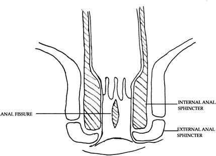 fitte all'ano|Anal Fissure (Fissure in Ano) .